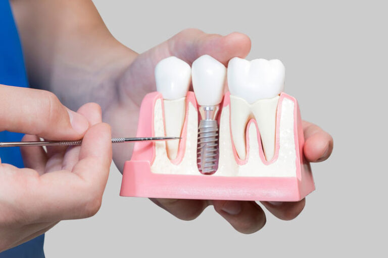 dental-implant-model-bone-cutaway