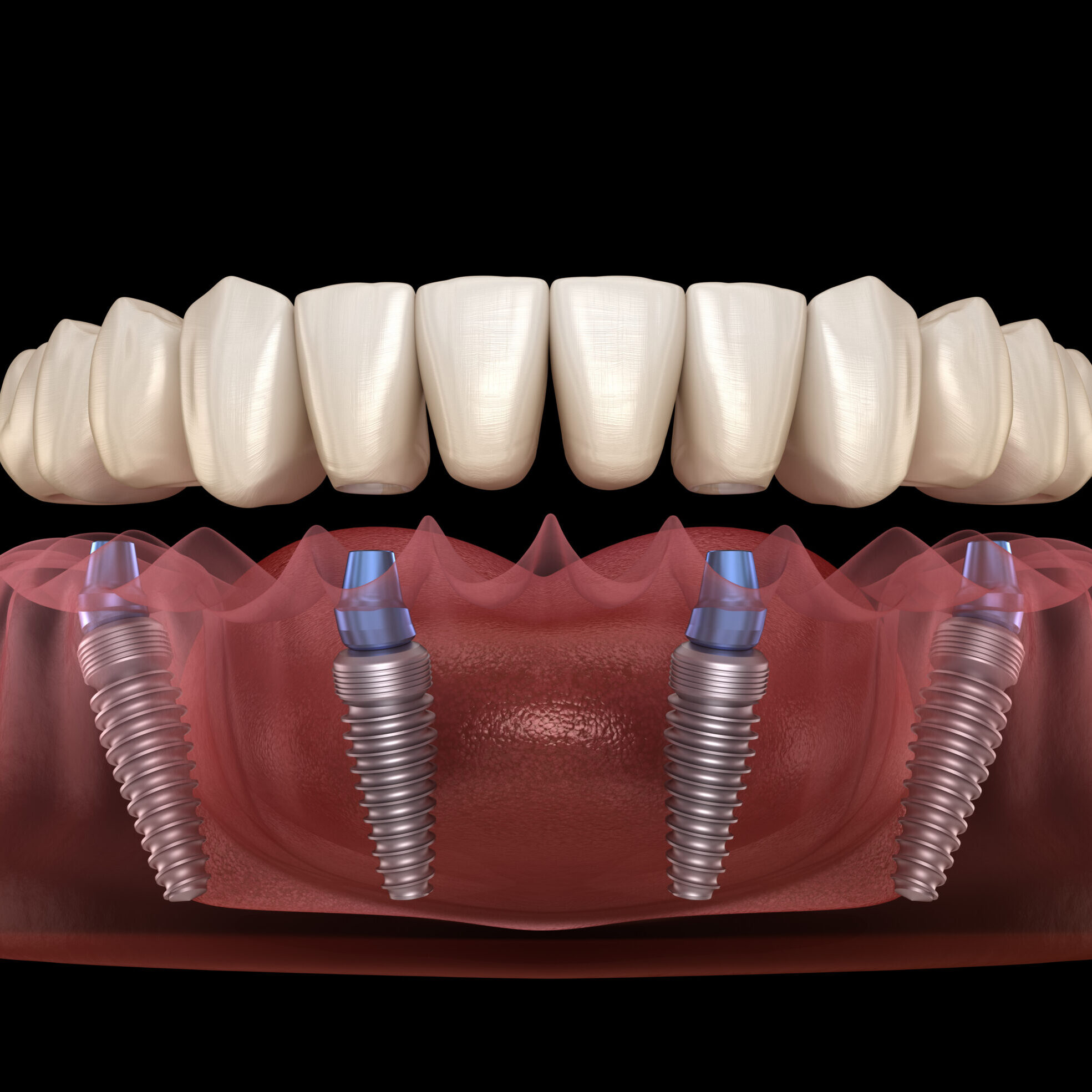 Dental prosthesis based on 4 implants. Dental 3D illustration